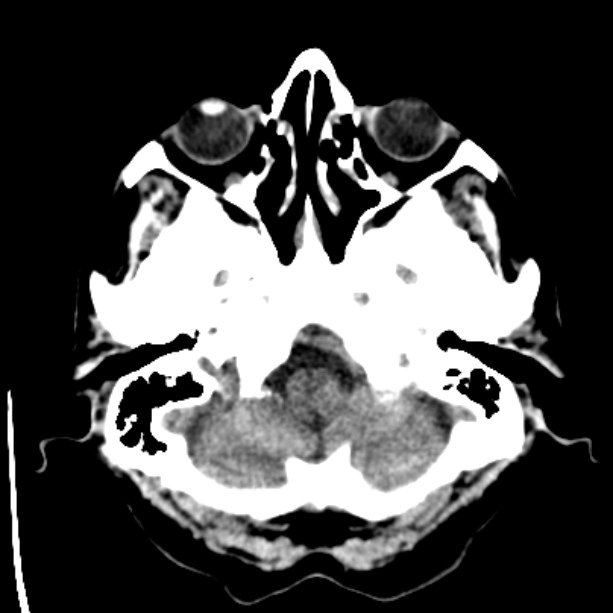 Bilateral subdural hygromata (Radiopaedia 29245-29656 Axial non-contrast 6).jpg