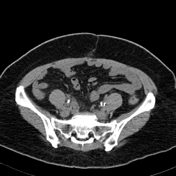File:Bilateral ureteric stents (Radiopaedia 48795-53825 Axial non-contrast 45).jpg