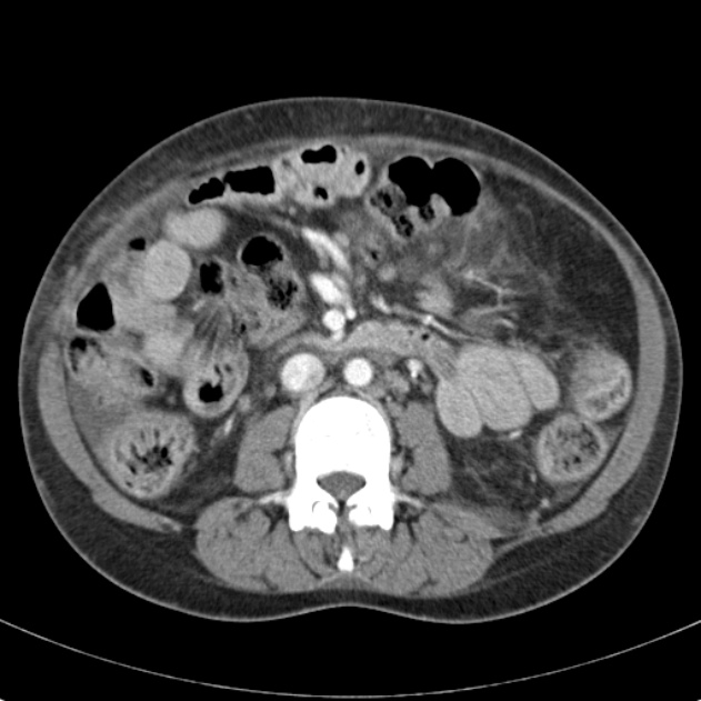 Biliary necrosis - liver transplant (Radiopaedia 21876-21846 B 38).jpg