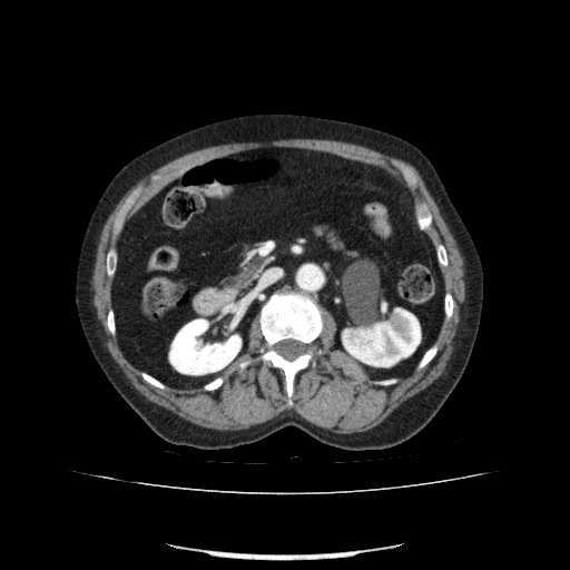 File:Bladder tumor detected on trauma CT (Radiopaedia 51809-57609 B 54).jpg