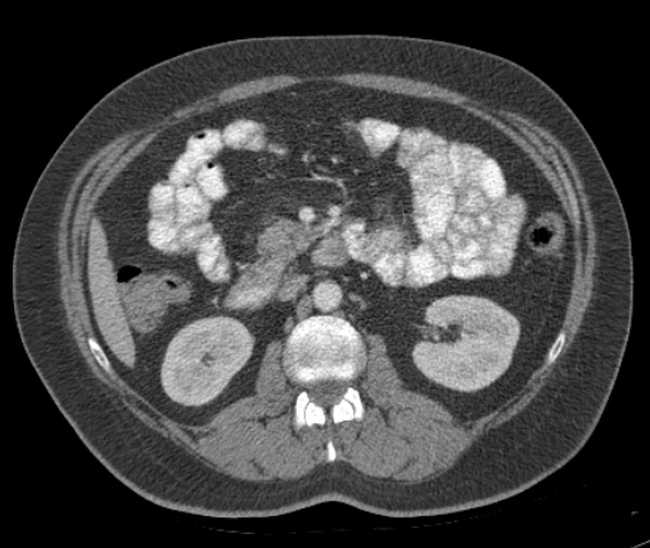 Bleeding duodenal ulcer and adenomyomatosis of gallbladder (Radiopaedia 61834-69861 A 54).jpg