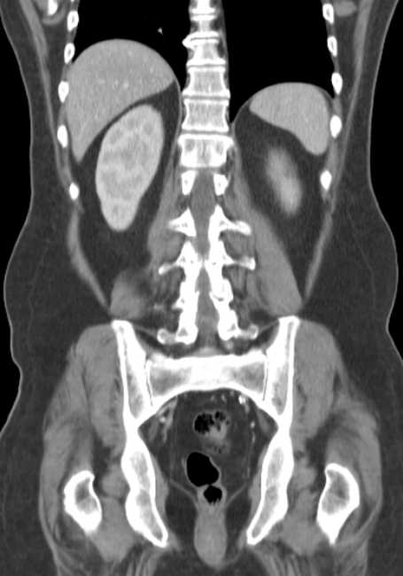 Bleeding duodenal ulcer and adenomyomatosis of gallbladder (Radiopaedia 61834-69861 B 23).jpg