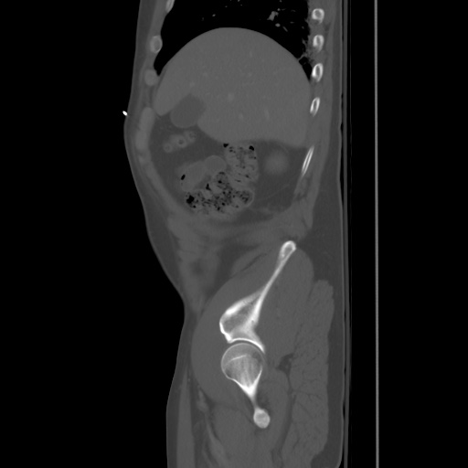 Blunt abdominal trauma with solid organ and musculoskelatal injury with active extravasation (Radiopaedia 68364-77895 Sagittal bone window 14).jpg