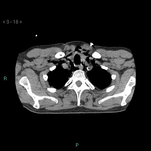 Boerhaave syndrome (Radiopaedia 27683-27897 oral contrast 18).jpg