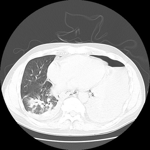 Boerhaave syndrome (Radiopaedia 59796-67310 Axial lung window 43).jpg
