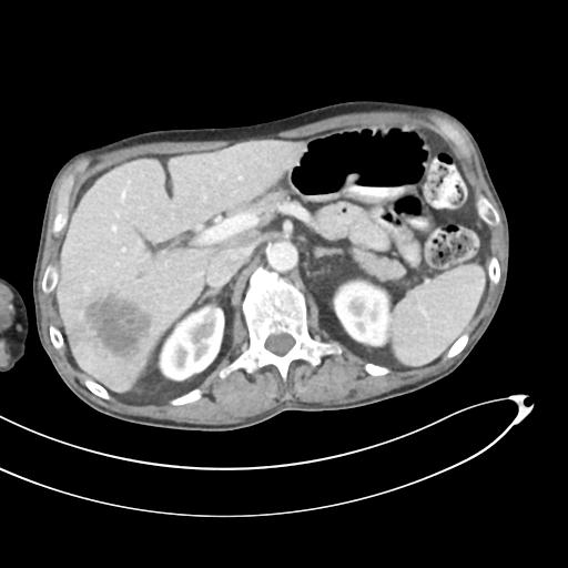 Bone metastasis from squamous cell carcinoma (Radiopaedia 30133-30730 B 22).jpg