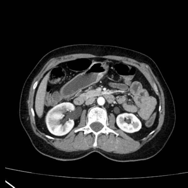 Bosniak renal cyst - type I (Radiopaedia 27479-27675 renal cortical phase 34).jpg