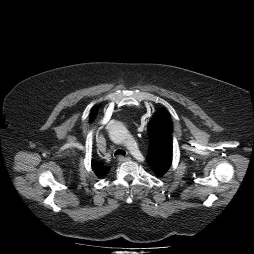 Bovine aortic arch - right internal mammary vein drains into the superior vena cava (Radiopaedia 63296-71875 A 25).jpg