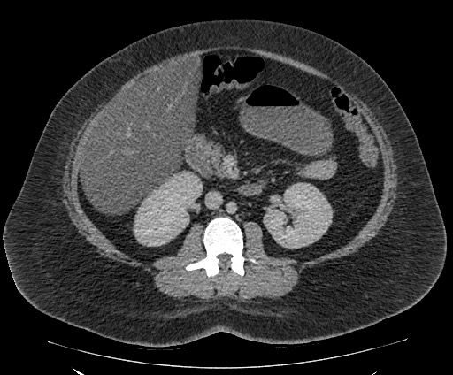 Bowel and splenic infarcts in acute lymphocytic leukemia (Radiopaedia 61055-68913 A 61).jpg