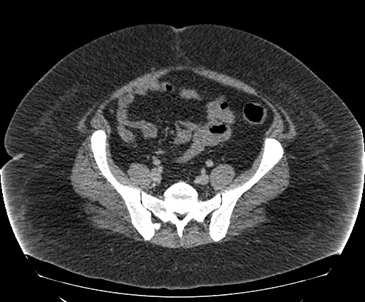 Bowel and splenic infarcts in acute lymphocytic leukemia (Radiopaedia 61055-68913 A 95).jpg