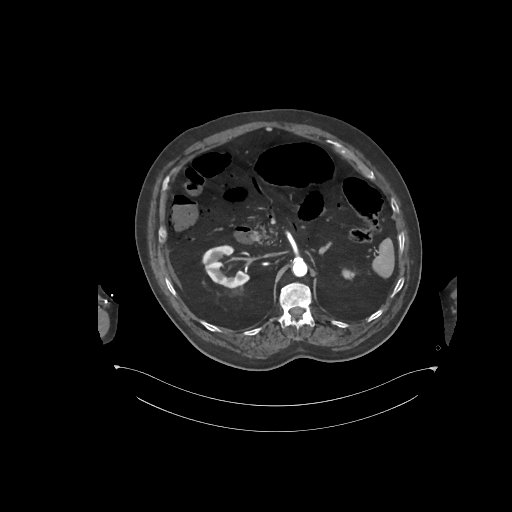 File:Bowel ischemia secondary to SMA occlusion with extensive portomesenteric venous gas (Radiopaedia 54656-60871 A 50).jpg