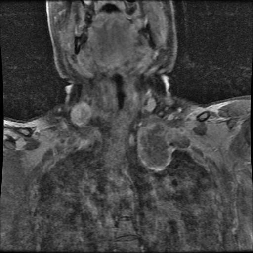 File:Brachial plexus neurofibroma (Radiopaedia 28030-28291 H 3).png