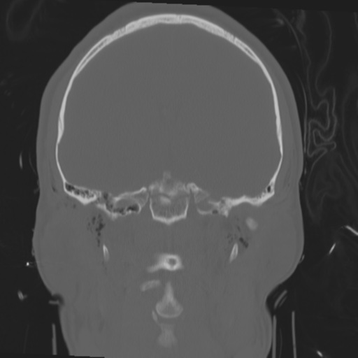 Brain contusions, internal carotid artery dissection and base of skull fracture (Radiopaedia 34089-35339 Coronal bone window 38).png