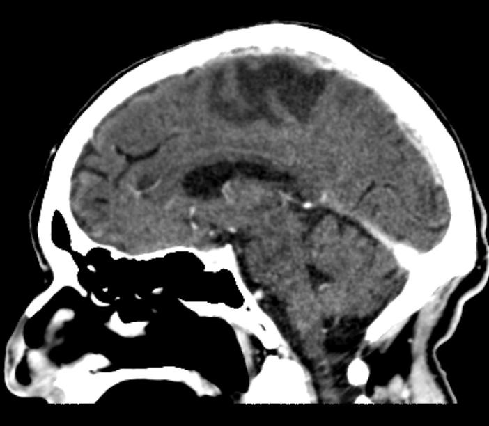 Brain metastases from lung cancer (Radiopaedia 27849-28092 Sagittal C+ delayed 30).jpg