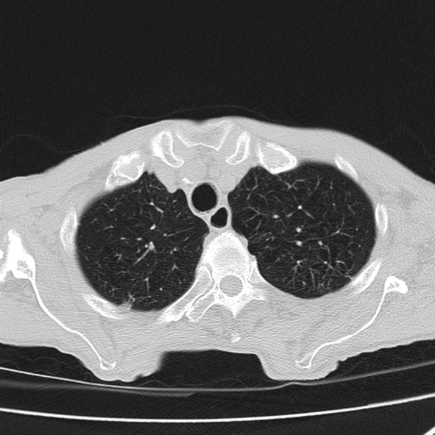 Brain metastases from lung cancer (Radiopaedia 27849-28093 Axial lung window 12).jpg
