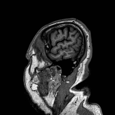 Brain metastases from lung cancer (Radiopaedia 83839-99028 Sagittal T1 9).jpg