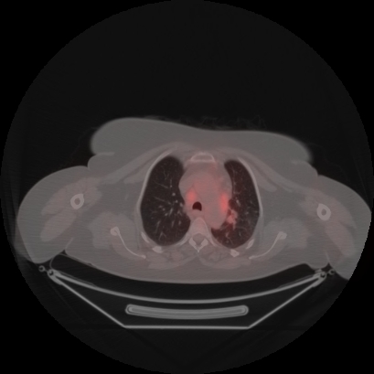 Brain metastasis (Radiopaedia 89847-106962 Axial lung window 15).jpg