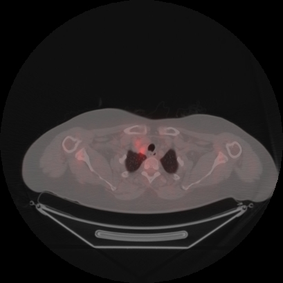 Brain metastasis (Radiopaedia 89847-106962 Axial lung window 2).jpg