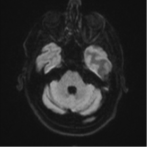 Brain metastasis (large cystic mass) (Radiopaedia 47497-52107 Axial DWI 35).png