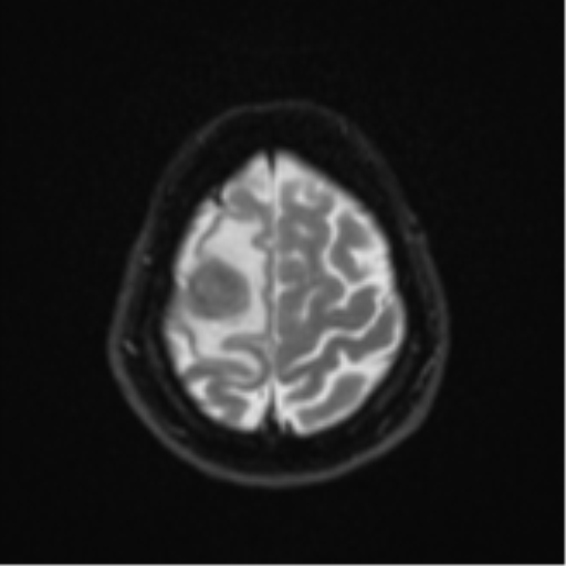 Brain metastasis (sarcoma) (Radiopaedia 47576-52209 Axial DWI 23).png