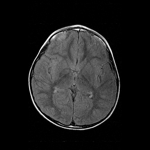 File:Brainstem ganglioglioma (Radiopaedia 10763-11224 Axial FLAIR 10).jpg