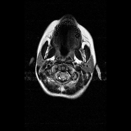 File:Brainstem ganglioglioma (Radiopaedia 10763-11224 Axial FLAIR 19).jpg