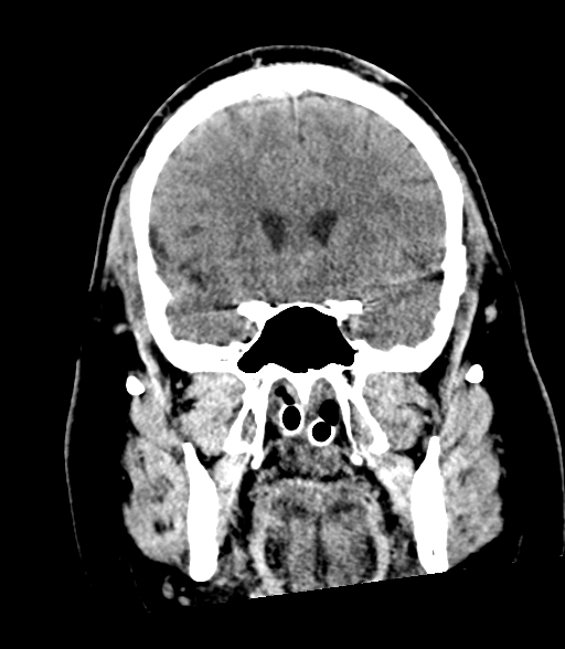 Brainstem hemorrhage (Radiopaedia 81294-94976 Coronal non-contrast 24).jpg