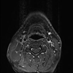 File:Branchial cleft cyst (Radiopaedia 31167-31876 Axial T1 C+ fat sat 9).jpg