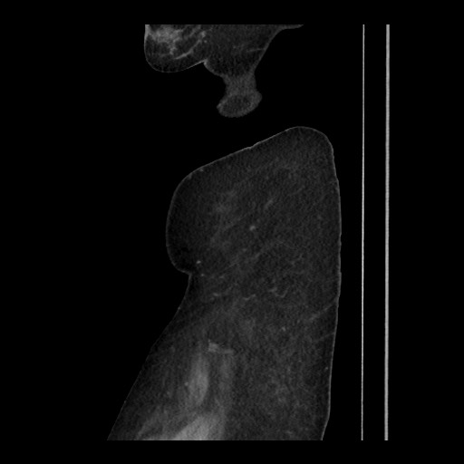 Breast cancer pseudocirrhosis (Radiopaedia 65406-74454 C 30).jpg