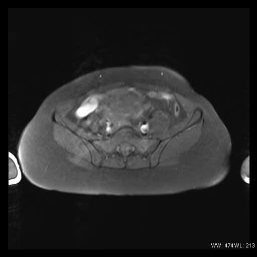 File:Broad ligament fibroid (Radiopaedia 49135-54241 Axial T1 fat sat 10).jpg