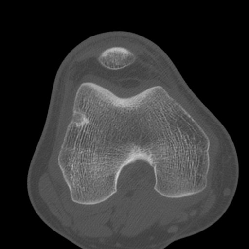 Brodie abscess of the tibia (Radiopaedia 58984-66250 Axial bone window 40).jpg