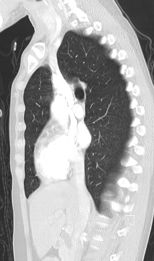 Bronchial atresia (Radiopaedia 73677-84470 Sagittal lung window 24).jpg