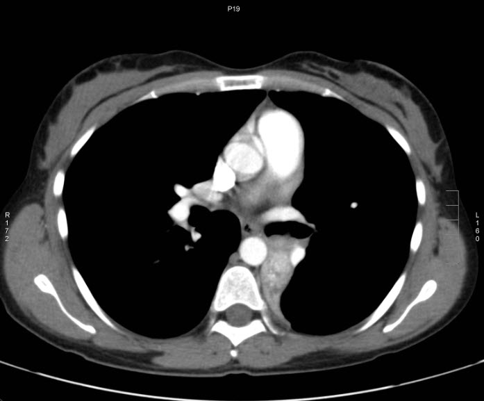 File:Bronchial carcinoid tumor (Radiopaedia 15042-42507 B 4).jpg