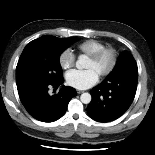 Bronchial carcinoid tumor (Radiopaedia 67377-76764 A 37).jpg