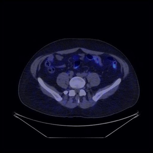 Bronchial carcinoid tumor (Radiopaedia 67377-76765 68Ga-DOTATATE PET-CT 61).jpg