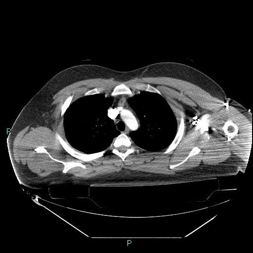 Bronchial carcinoid tumor (Radiopaedia 78272-90870 B 36).jpg