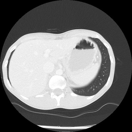 Bronchial carcinoid tumor causing right lower lobe collapse (Radiopaedia 83495-98594 Axial lung window 52).jpg