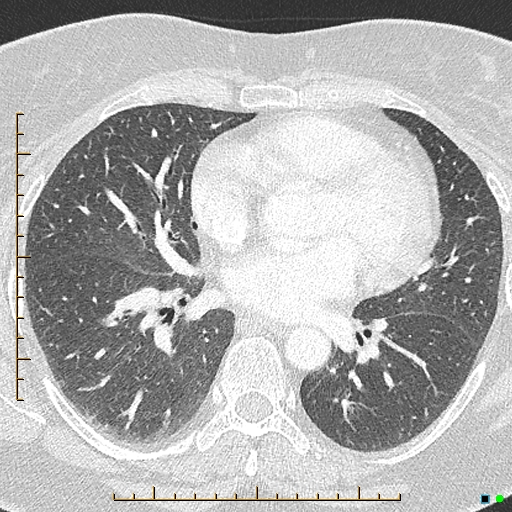 Bronchial diverticula (Radiopaedia 79512-92676 Axial lung window 111).jpg