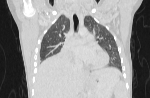 Bronchial mucoepidermoid carcinoma (Radiopaedia 57023-63895 Coronal lung window 7).jpg