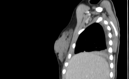 Bronchial mucoepidermoid carcinoma (Radiopaedia 57023-63895 Sagittal 7).jpg
