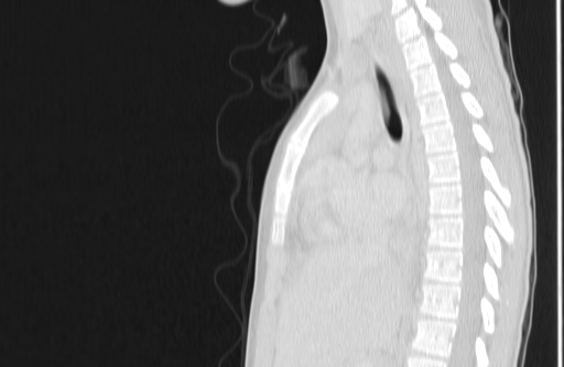 Bronchial mucoepidermoid carcinoma (Radiopaedia 57023-63895 Sagittal lung window 81).jpg