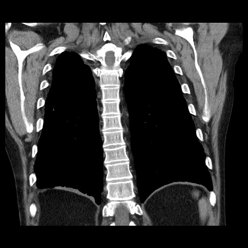 Bronchial stenosis - lung transplant (Radiopaedia 73133-83848 Coronal non-contrast 49).jpg