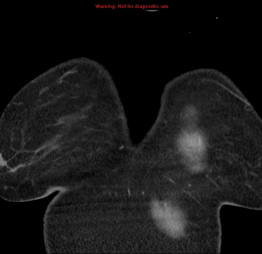 File:Bronchoalveolar carcinoma (BAC) (Radiopaedia 13436-13392 E 2).jpg