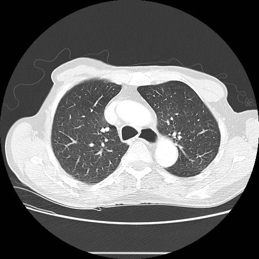 Bronchocele (Radiopaedia 17097-16795 Axial lung window 37).jpg