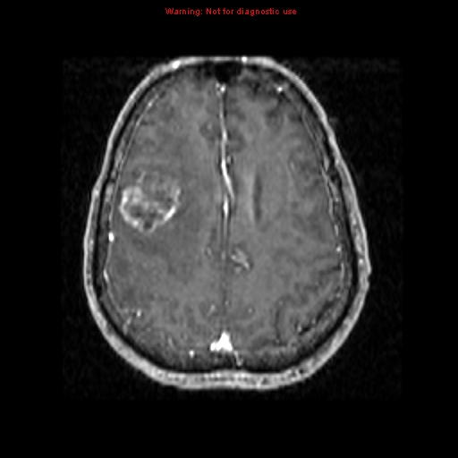 File:Bronchogenic carcinoma brain metastasis (Radiopaedia 9286-9969 Axial T1 C+ 16).jpg