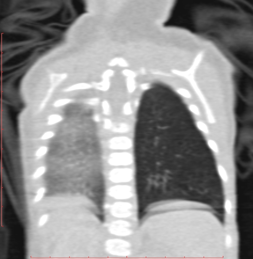 File:Bronchogenic cyst (Radiopaedia 78599-91409 Coronal lung window 177).jpg