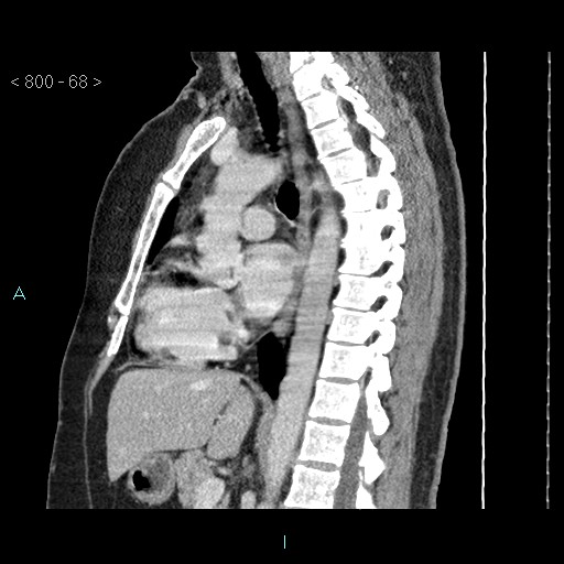 Bronchogenic cyst - posterior mediastinal (Radiopaedia 43885-47364 B 45).jpg