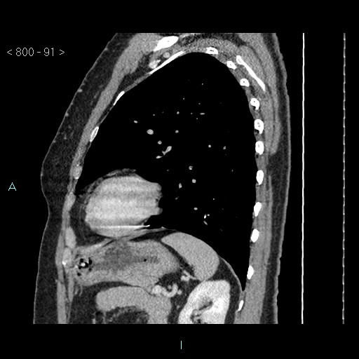 File:Bronchogenic cyst - posterior mediastinal (Radiopaedia 43885-47364 B 60).jpg