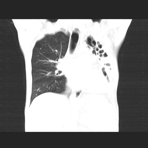 File:Bronchopleural fistula secondary to tuberculosis (Radiopaedia 20415-20322 Coronal lung window 10).jpg