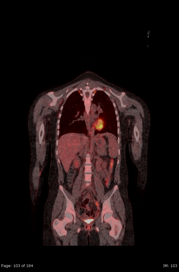 Brown fat uptake (FDG PET-CT) (Radiopaedia 77392-89513 Fused coronal 61).jpg
